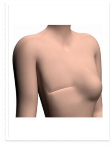 breast prosthesis fitting in india